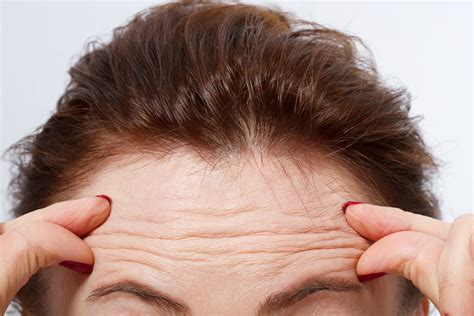 Forehead Wrinkles: How to Get Rid of Them