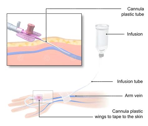 Illustration infusion - MedicalGraphics