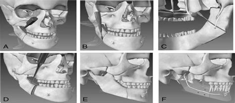 Bilateral Sagittal Split Osteotomy: Description of Surgical... : Journal of Craniofacial Surgery