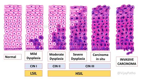 Cervical intraepithelial neoplasia & cervical cancer - Pathology Made Simple