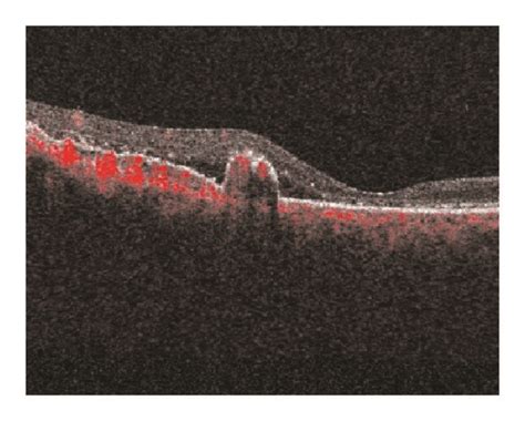 OCT-Angiography (OCT-A) images of the right eye at the 7-month ...