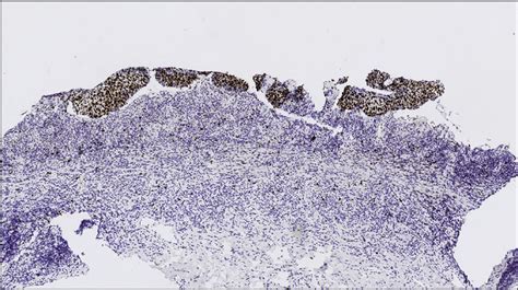 Erythroplasia Of Queyrat Symptoms