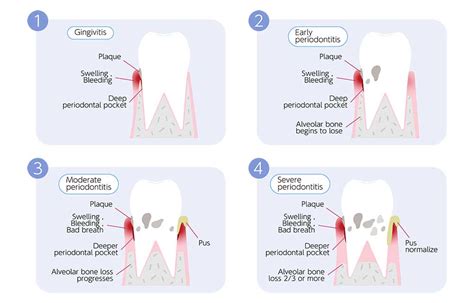 Periodontal Disease Stages