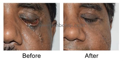 Cheekbone fracture surgery and lower eyelid correction | Cheekbone ...