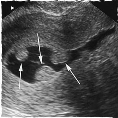 Uterine Polyp Removal Hysteroscopy