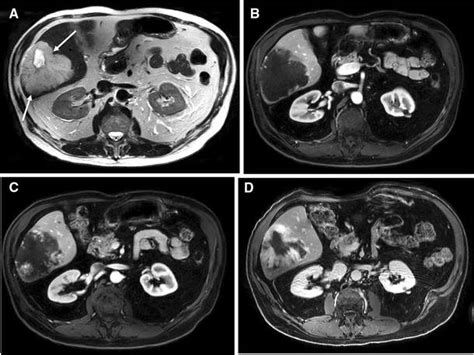 MRI of liver hemangioma. The axial T2-weighted image a shows a giant... | Download Scientific ...