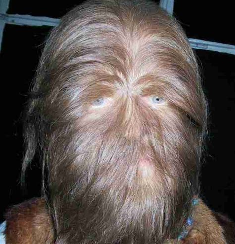 Hypertrichosis: The Werewolf Syndrome - EVERYTHING UNEXPLAINED