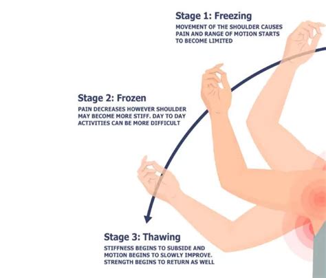 What is Frozen Shoulder? Causes, Symptoms, and Treatment Options