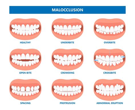 Severe Overbite Invisalign