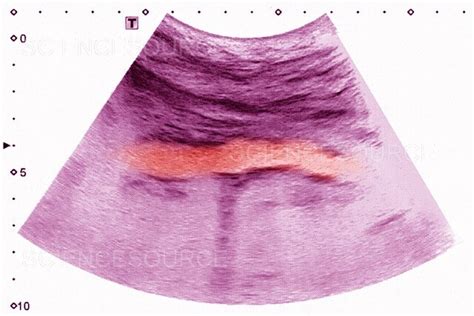 Calcific aortic atheroma, ultrasound | Stock Image - Science Source Images