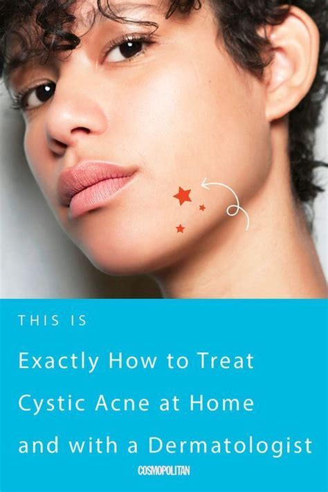 Cystic Acne Extraction Video: A Guide To Clearing Your Skin – Universe Rant