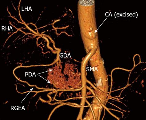 Radiology Anatomy Images : Celiac artery and its branches 3D CT Anatomy