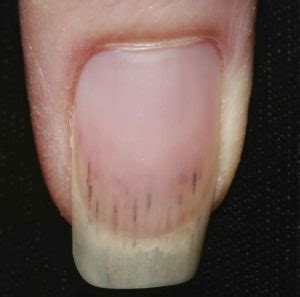 Splinter hemorrhages causes, what it looks like, diagnosis & treatment