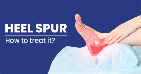 What is a heel spur? - Symptoms, Causes, Risk factors, and Treatment