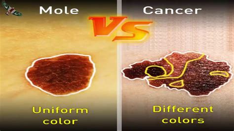 normal mole vs cancerous skin - YouTube