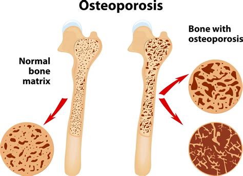 Metabolic Syndrome Research and CBD (Cannabidiol) - I want my CBD