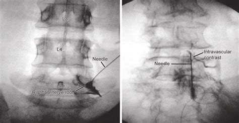 a and B: (A) Transforaminal injection at right L5 nerve root; (B ...