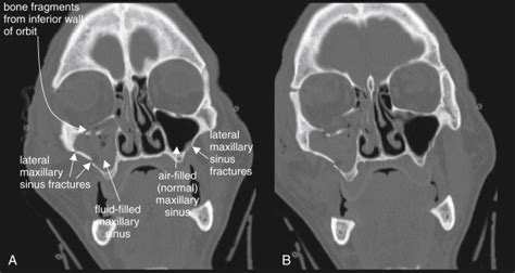 Imaging the Face | Radiology Key