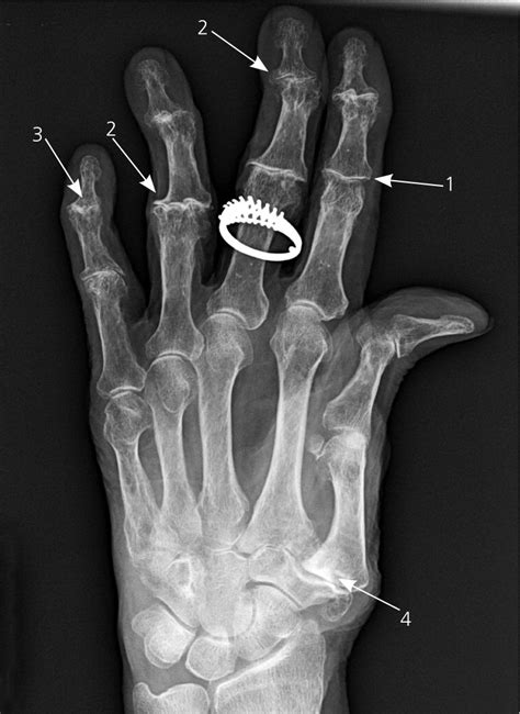 Osteoarthritis Hands X Ray