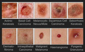 Types Of Skin Lesions : Skin Lesions Symptoms Causes And Treatment ...