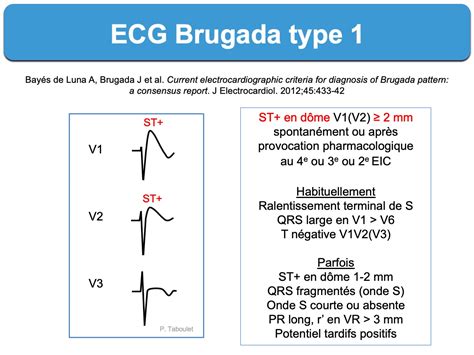 Brugada Pattern, Brugada Phenocopy, What to Think? International Journal of Cardiovascular