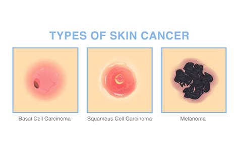 Skin Cancer Cells Vs Normal Cells