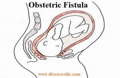 Obstetric Fistula – Causes, Complications, and Treatment.