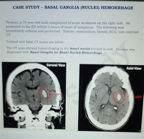 Solved CASE STUDY - BASAL GANGLIA (NUCLEI) HEMORRHAGE | Chegg.com