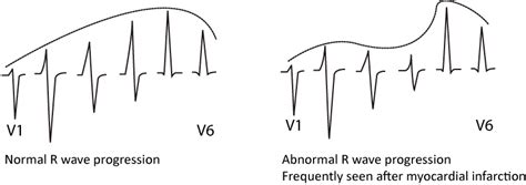 Other ECG changes in ischemia and infarction – ECG learning