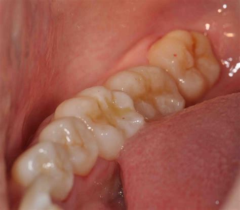 Related Keywords & Suggestions for molar teeth