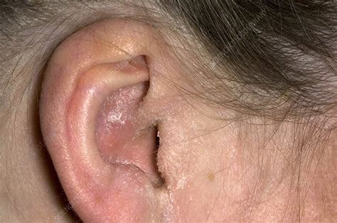 Outer ear infection - Stock Image - M157/0086 - Science Photo Library