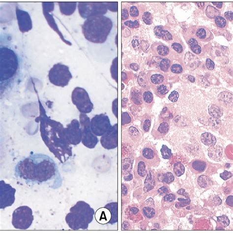 The findings at the diagnosis of myelodysplastic syndrome associated ...