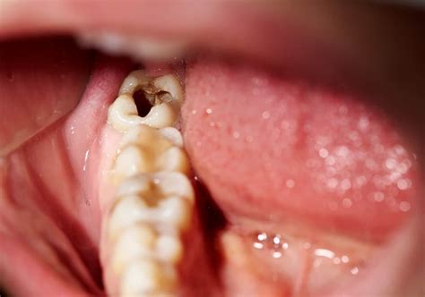 What Causes a Tooth Infection?