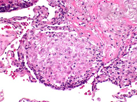 Sarcoidosis - Non-necrotizing granuloma | The characteristic… | Flickr