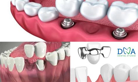 Dental Bridges and Their Various Types