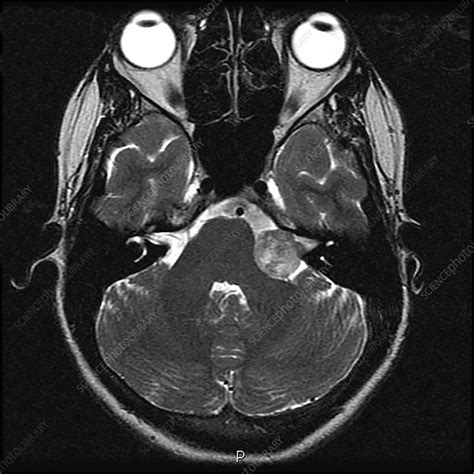 Vestibular Schwannoma, MRI - Stock Image - C039/4308 - Science Photo Library