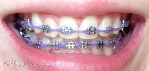 lilac/ lavender braces: power chain in 2020 | Braces teeth colors, Cute braces, Braces colors