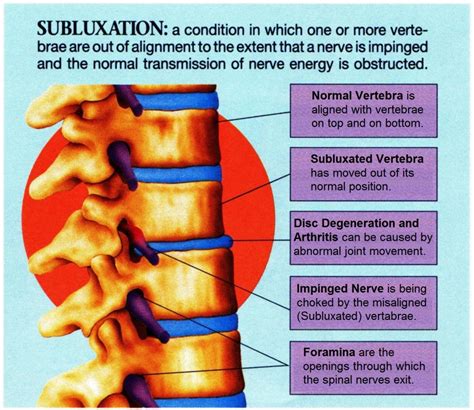 Subluxation | Premier Chiropractic Centre