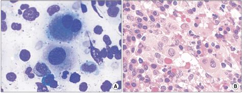 The findings at the diagnosis of myelodysplastic syndrome associated ...