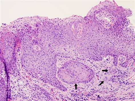 Invasive squamous cell carcinoma causing laryngeal leukoplakia | Iowa ...