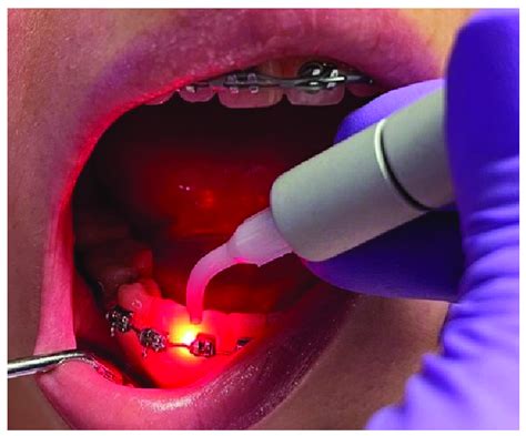 Laser therapy applied to a patient with a fixed orthodontic device ...