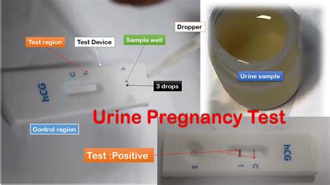 Urine Pregnancy Test: Introduction, Principle, Procedure, Result Interpretat