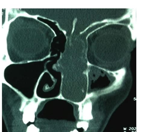 Contrast enhancing CT scan of Nose and PNS (coronal cut) showing... | Download Scientific Diagram