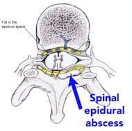 High risk back pain: Spinal Epidural Abscess