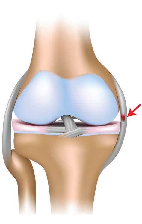 MCL Tear | MCL Injury | MCL Insufficiency | Orthopedic Knee Specialist ...