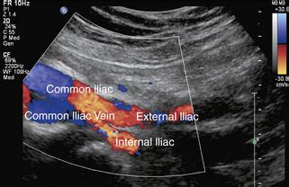 Ultrasound Assessment of Lower Extremity Arteries | Radiology Key