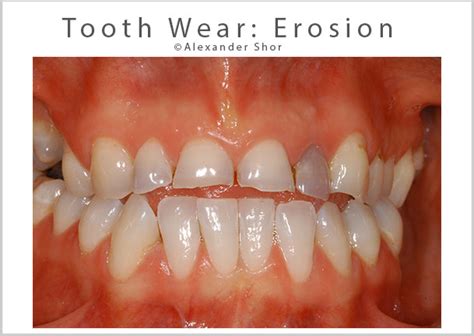 Tooth Wear Treatment Seattle - Shor Dental