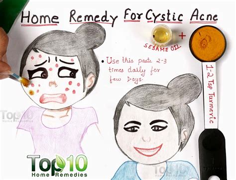 Home Remedies for Cystic Acne | Top 10 Home Remedies