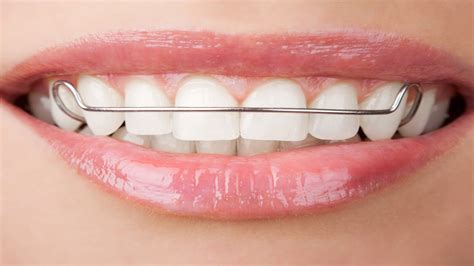 Plastic Vs. Metal Retainers: Which One Is Better?