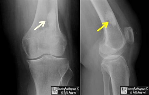 Giant Bone Island: Frontal and lateral knee radiographs show a large, well-circumscribed, ovoid ...